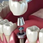 تبلیغ ایمپلنت فوری دروغ است/ سلبریتی‌ها حق تبلیغ خدمات پزشکی را ندارند_693066477841f.jpeg