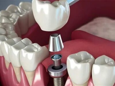 تبلیغ ایمپلنت فوری دروغ است/ سلبریتی‌ها حق تبلیغ خدمات پزشکی را ندارند